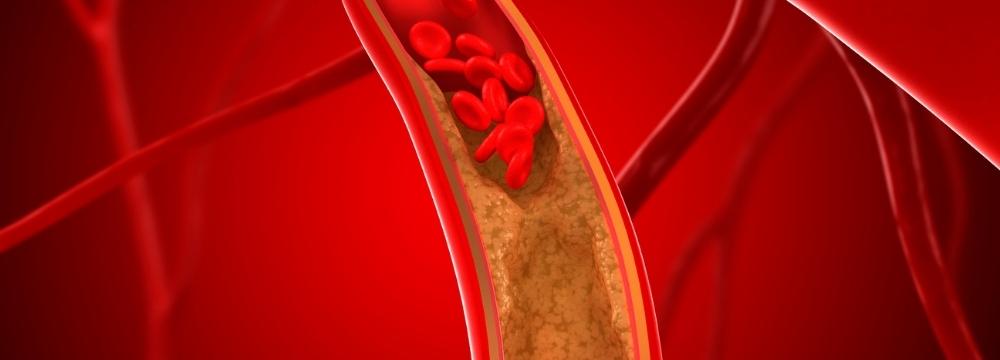 Unclogging Your Arteries Naturally – Is It Possible?